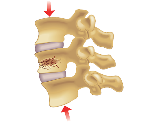 Vertibral compression fracture vertibral compression fracture