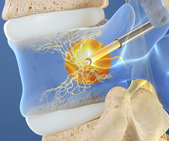 Intracept procedure intracept procedure